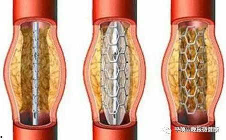 心脏支架进口和国产的区别,进口与国产差异解析